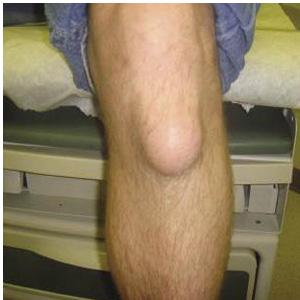 http://www.makehealtheasy.com/images/stories/Left_Section/a-sign-of-bursitis-on-a-leg-joint.jpg
