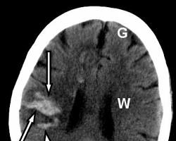Imagen de Imagen de tomografía computarizada de un cerebro