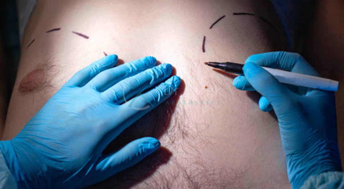 Plastic Surgeon For Gynecomastia An Overview By Dr.tarek