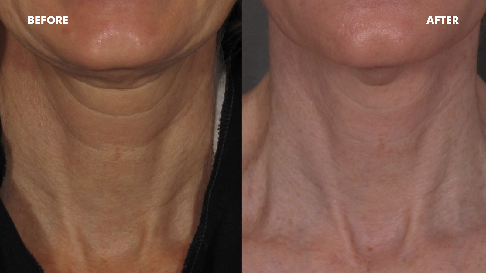 Before and after of neck.