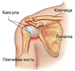 Бурсит сустава - лечение и симптомы, причины заболевания, какой врач лечит