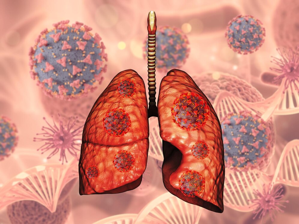 Ung thư phổi là bệnh lý ác tính có tỷ lệ tử vong cao