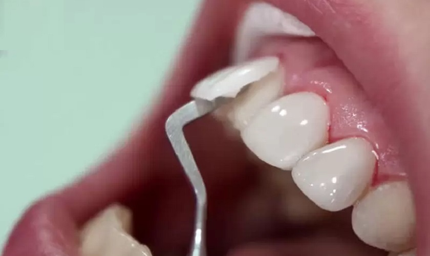Bọc răng sứ xong có tháo ra được không?