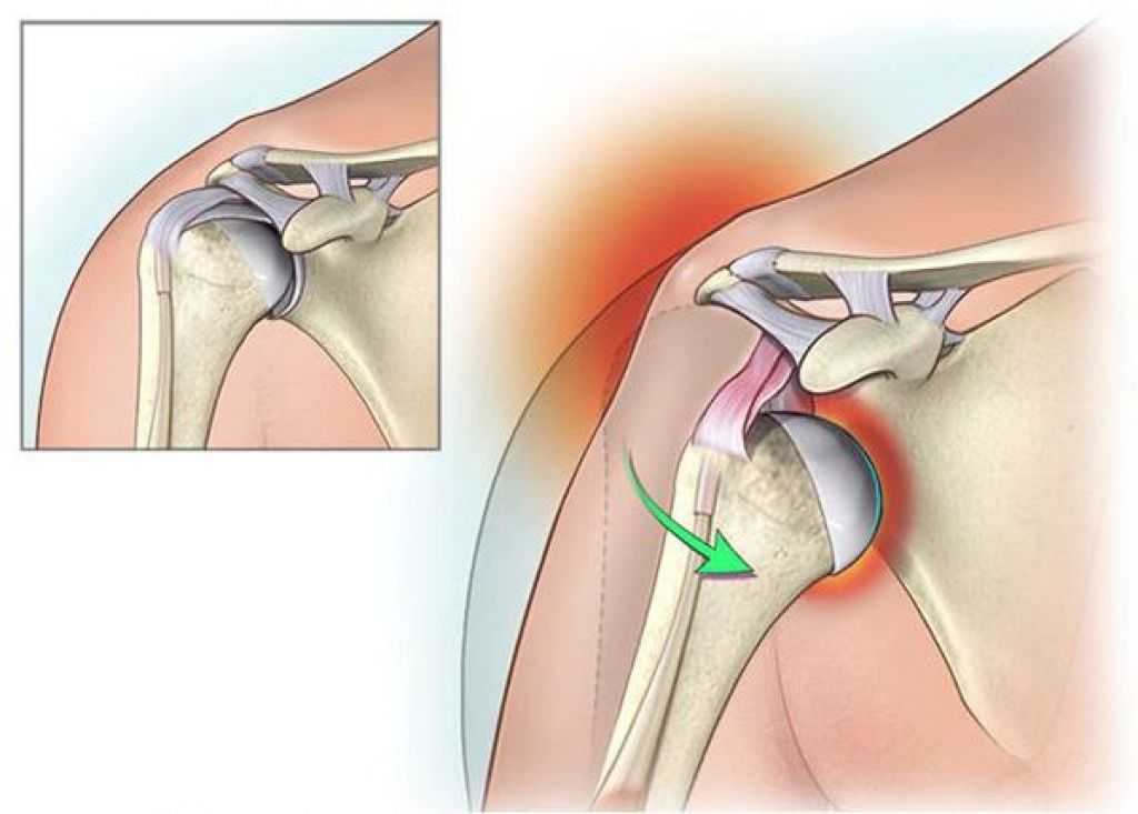 Вывих плеча: как распознать и вылечить