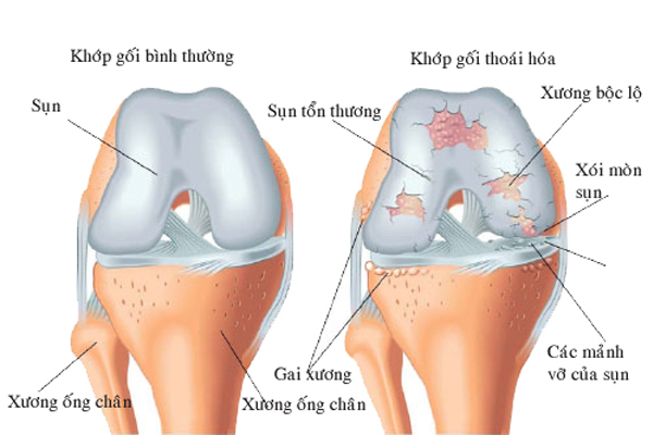 thoai-hoa-khop-1