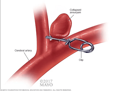 brain aneurysm 1