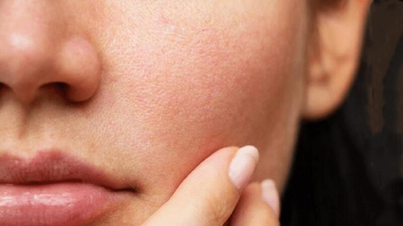 Da nhạy cảm cần có chế độ chăm sóc đặc biệt
