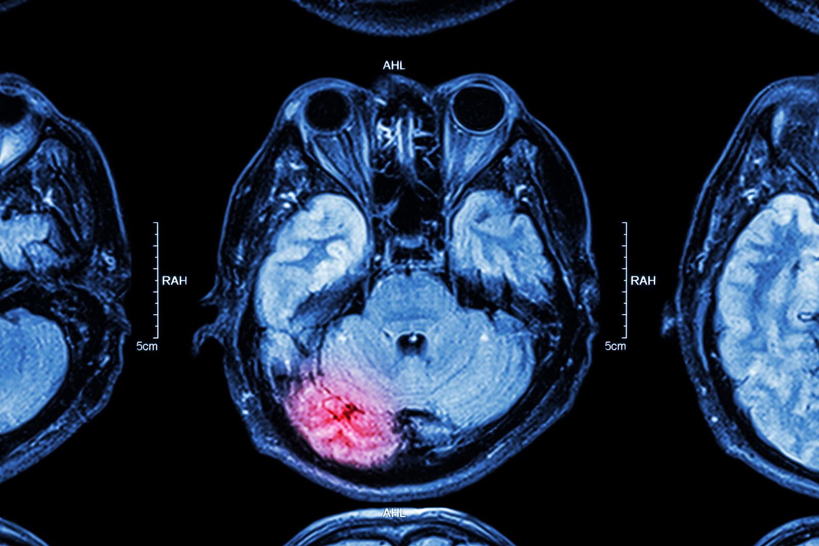 brain injuries caused by motor vehicle accidents