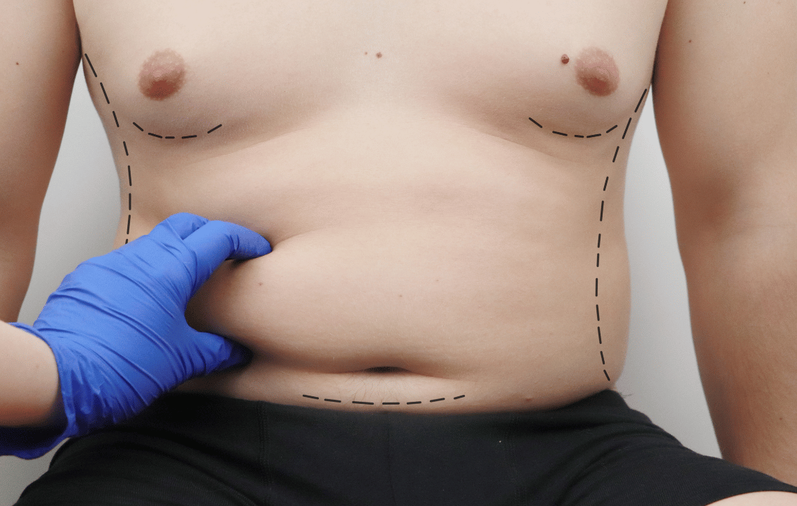 Liposuction graphic