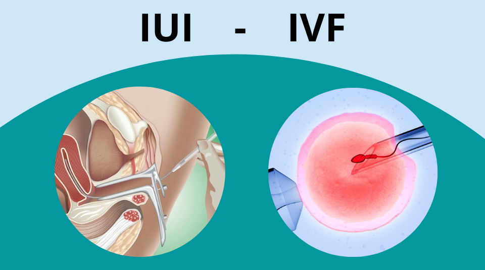 Sự khác biệt giữa IVF và IUI là gì? Bạn nên lựa chọn IUI hay IVF?