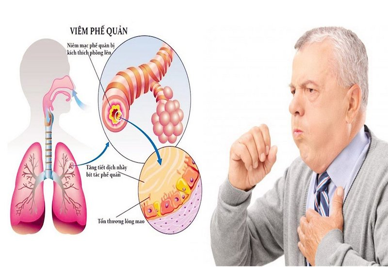 Triệu chứng bệnh phổi 2