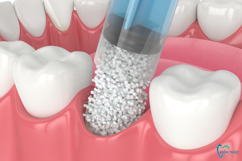 Lưu ý sau khi trồng răng implant