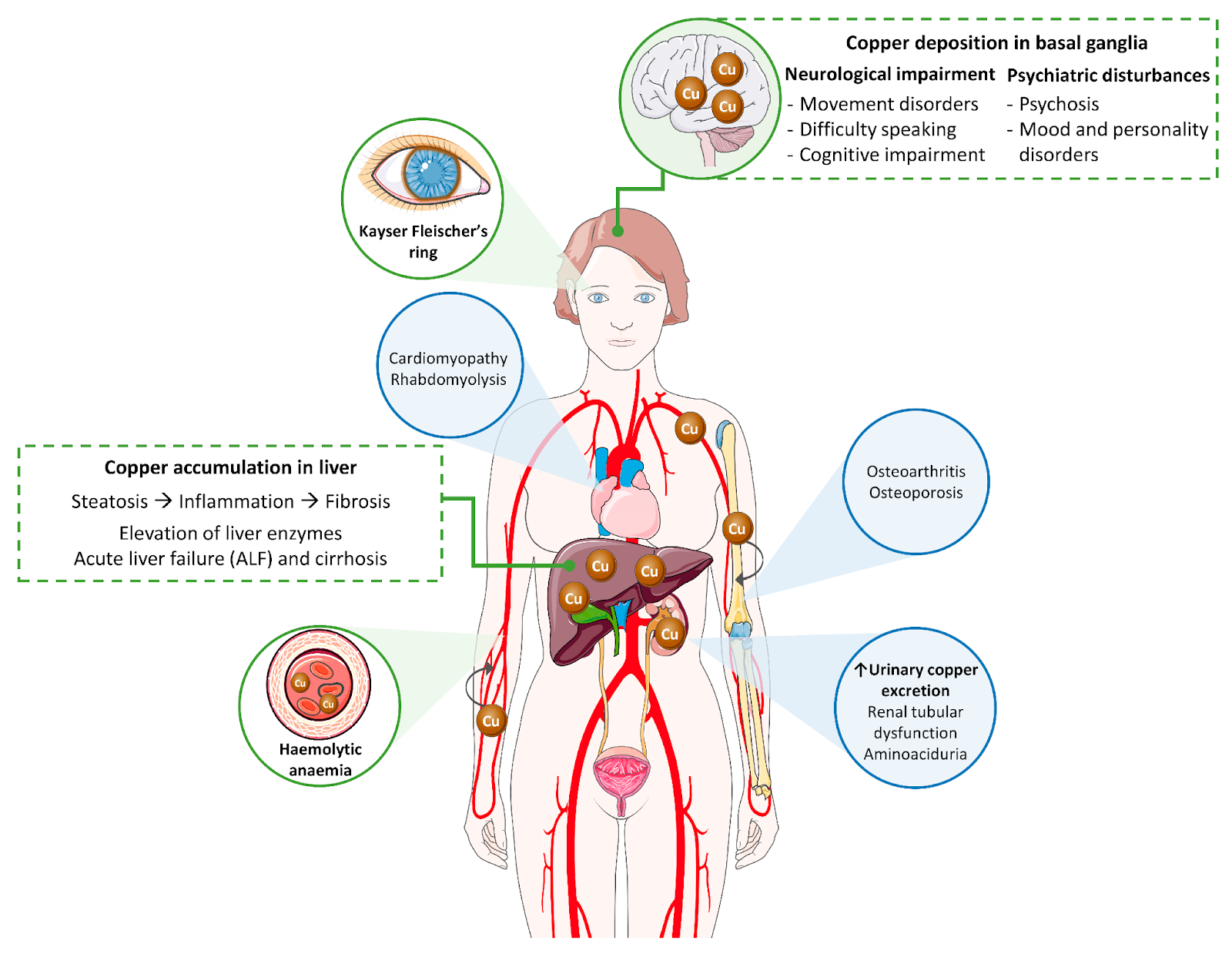 What Is Wilson's Disease - Klarity Health Library