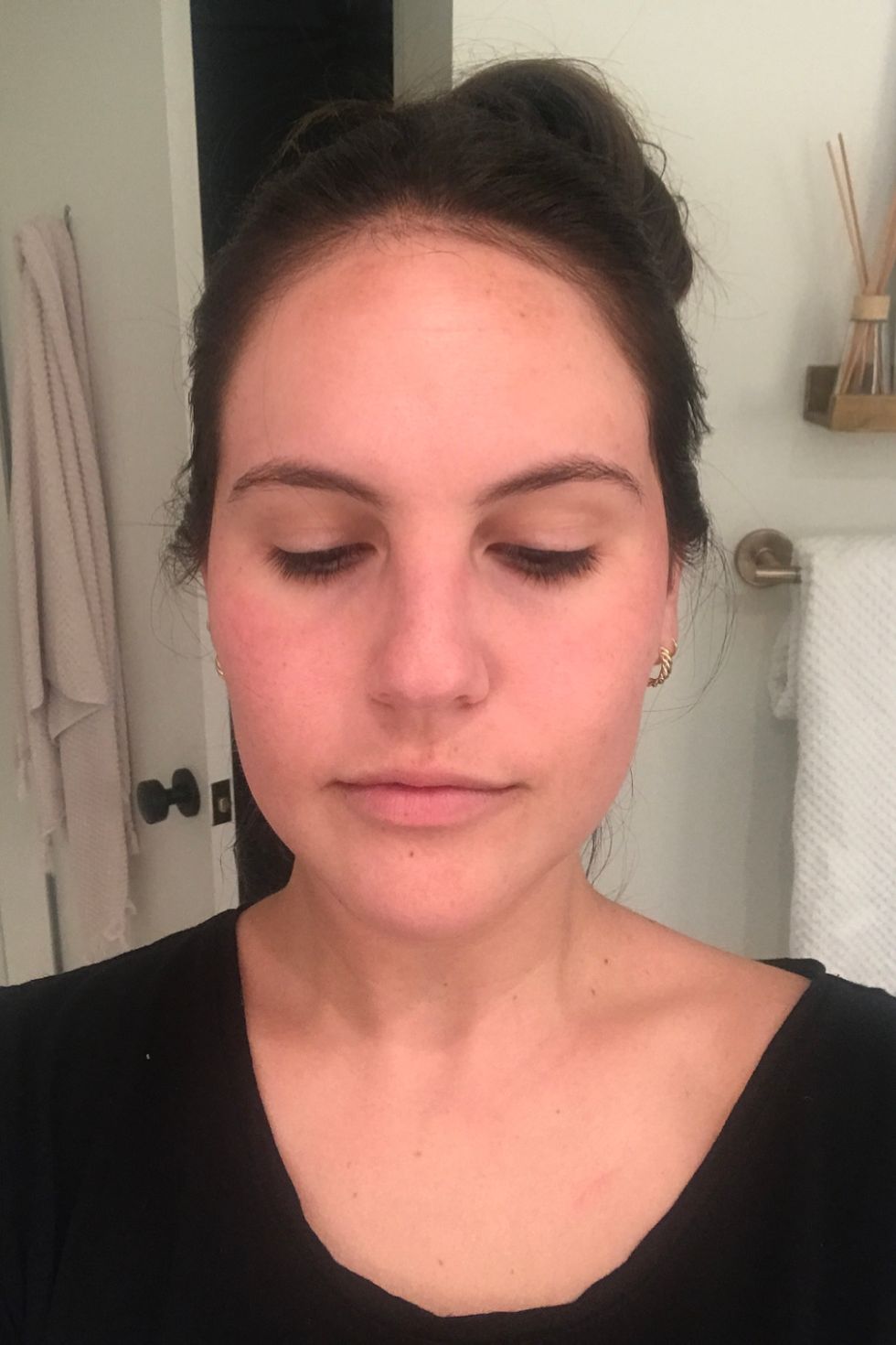 1 Month After Vampire Facial