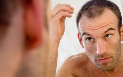 Erkek Saç Dökülmesi Nedenleri