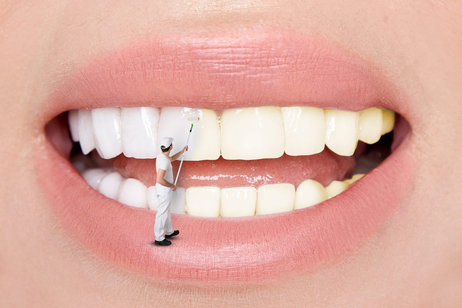 Are Temporary Dental Veneers Good for Me?