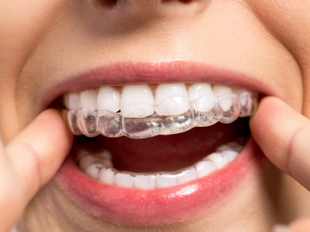 A woman wearing her retainer