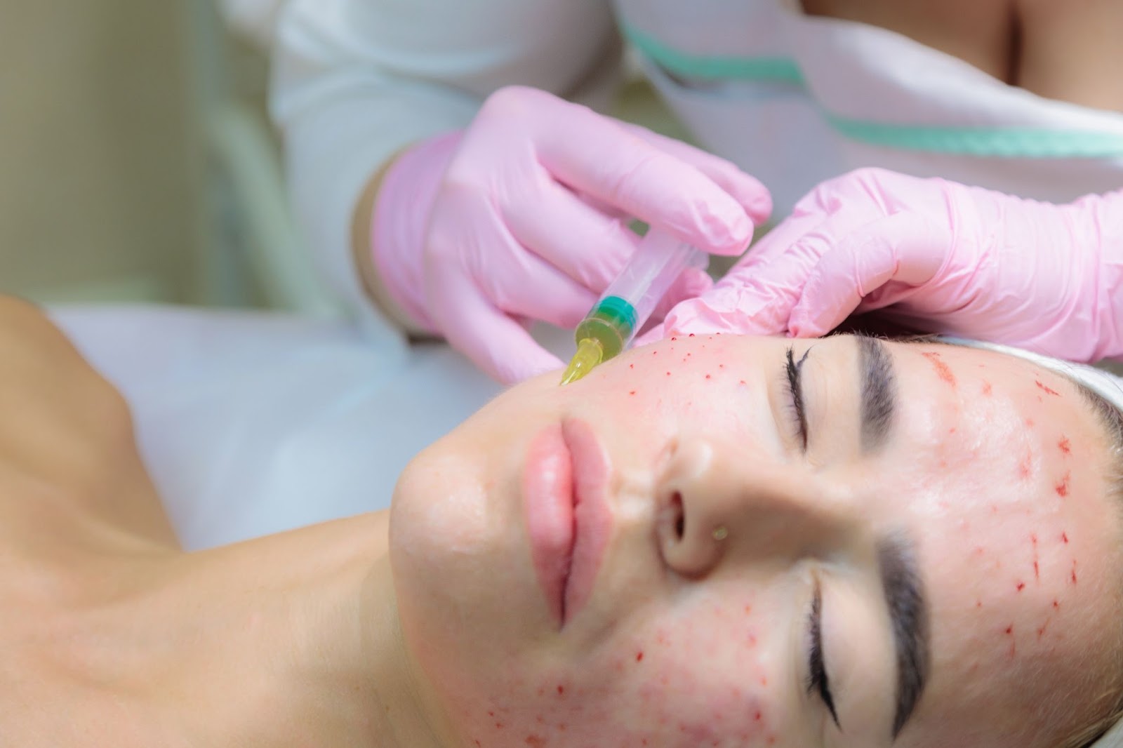 The doctor gives injections of blood plasma into the face of a young girl. PRP being used for a vampire facial.