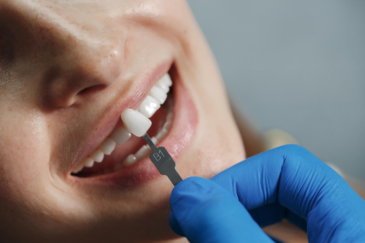 Keo dán răng sứ là một trong những vật liệu quen thuộc được dùng nhiều trong nha khoa