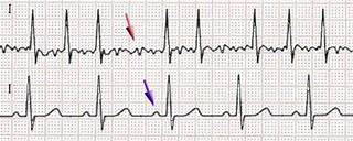 Atrial fibrillation