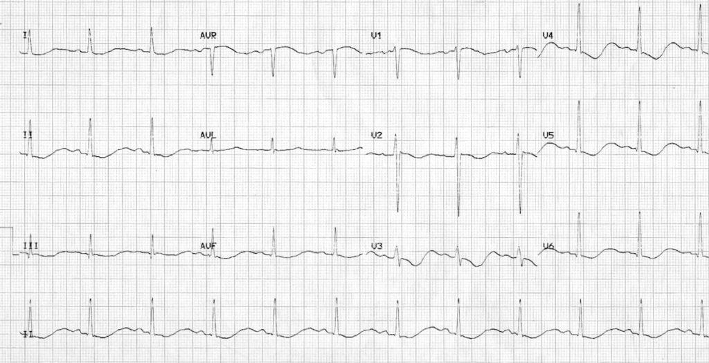 ECG severe hypokalemia serum potassium 1.7