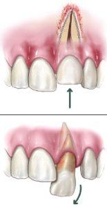 https://www.aae.org/patients/wp-content/uploads/sites/3/2017/11/dislodged-tooth-155x300.jpg