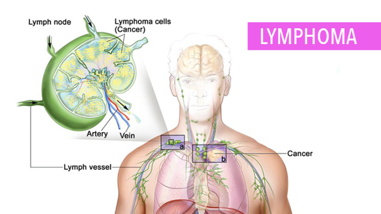 Lymphoma