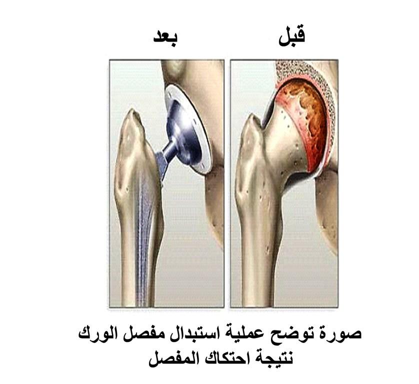 C:\Users\home\Desktop\كبار السن\مفصل الورك.jpg