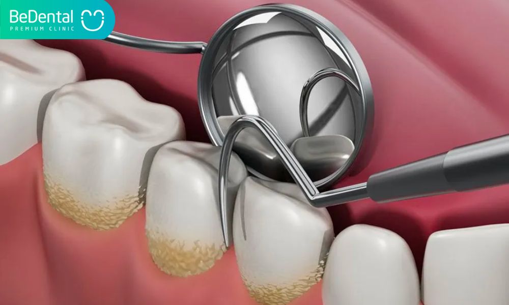 Vietnam Best Dentist for Scaling and Polishing