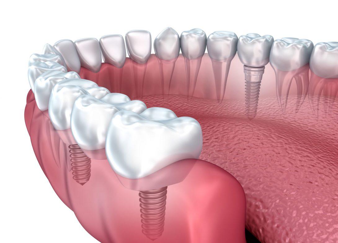 dental implants center in Toronto