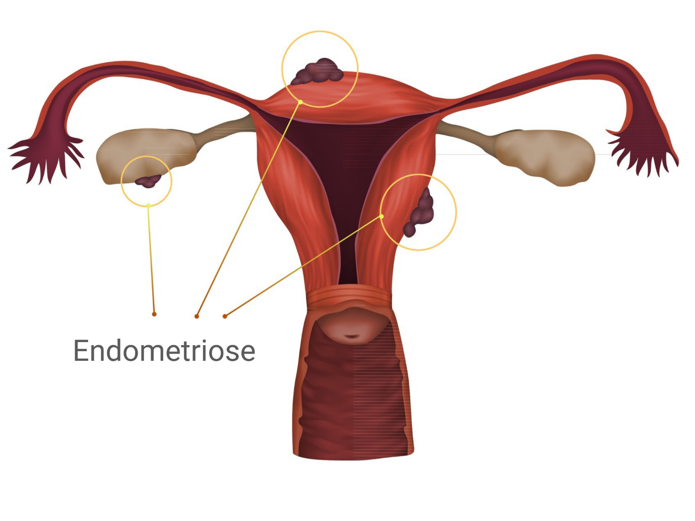 Endometriose: o que é esta doença?