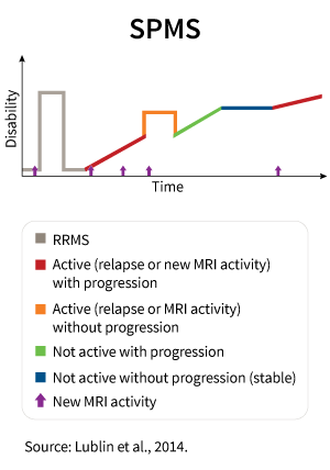 This graphic shows the kinds of disease activity that may occur in SPMS over time.