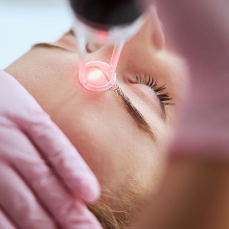 Opt for a Laser Toning treatment if you have acne scars, hyperpigmentation, and uneven skin tone