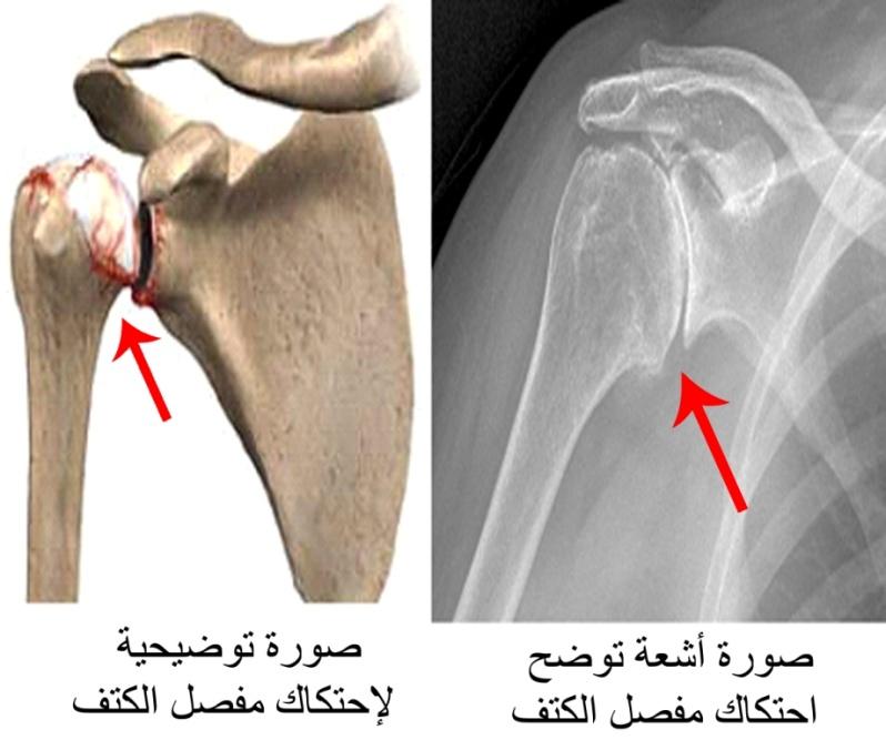 E:\Documents and Settings\USER\Desktop\كبار السن\احتكاك الكتف.jpg