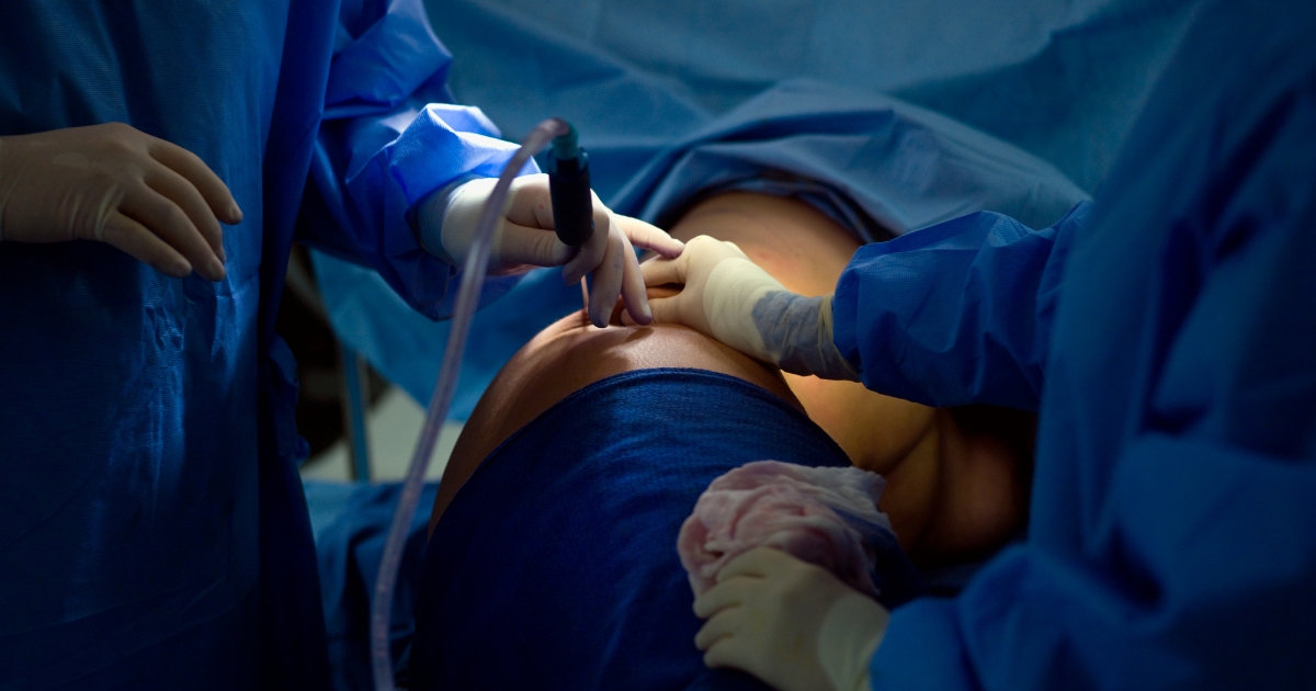 How Much Fat Is Safe To Remove In Liposuction
