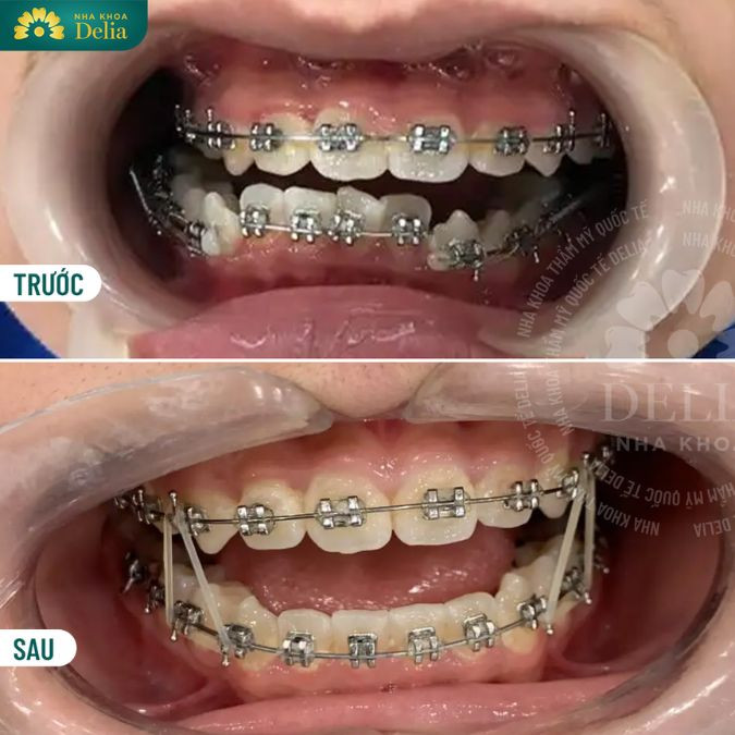 niềng răng khểnh sử dụng khí cụ chỉnh nha mắc cài, dây cung hay máng niềng răng trong suốt gắn lên răng