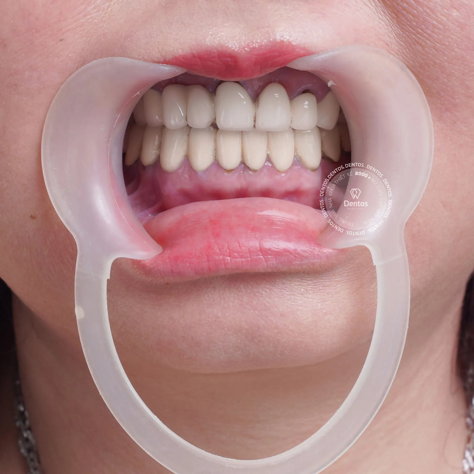 Tìm hiểu ưu & nhược điểm của các loại răng sứ hiện nay - Lựa chọn nào phù hợp với  bạn?