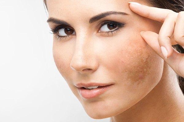 Melasma vs Dark Spots: Spot the Difference - DermaSpark Products Inc.