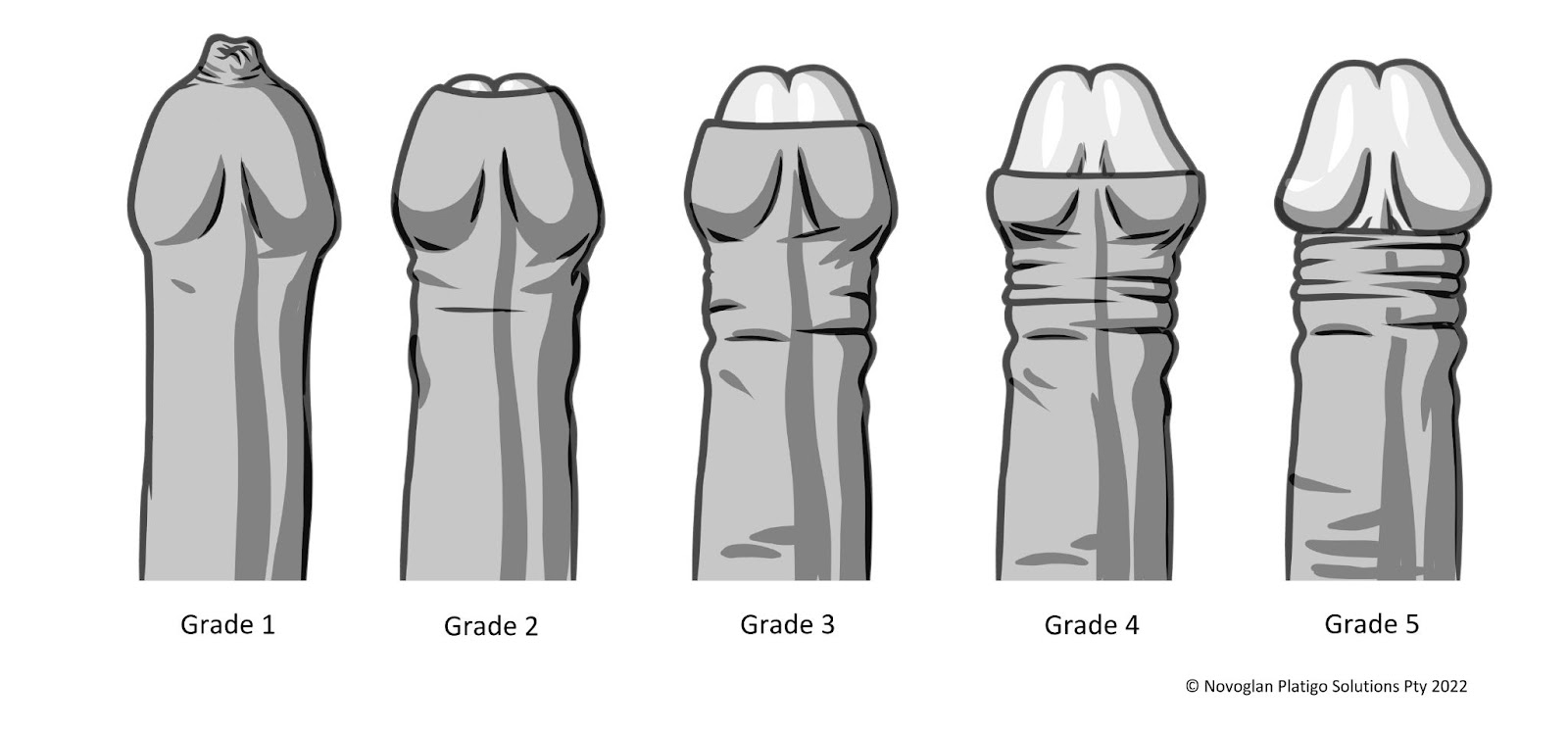 The different grades of phimosis 