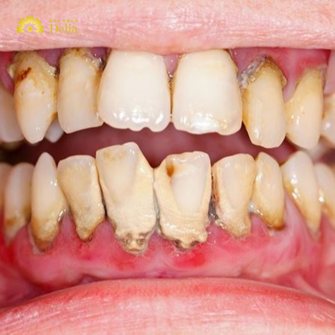 Mắc các bệnh lý răng miệng khiến răng yếu hơn