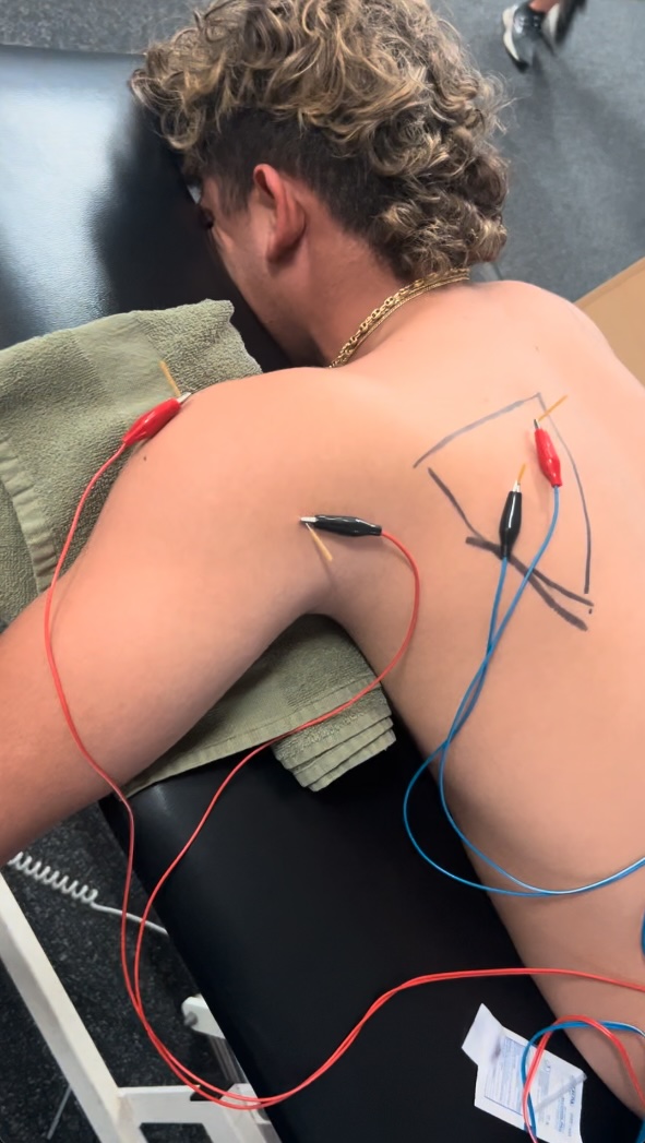 Shoulder Dry Needling