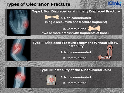 Types of Olecranon Fracture