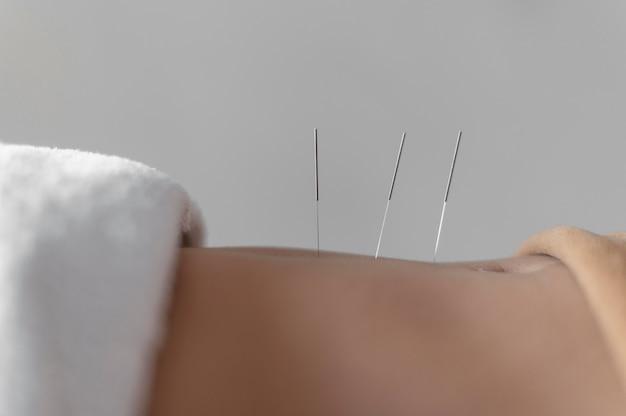 Close-up acupuncture procedure