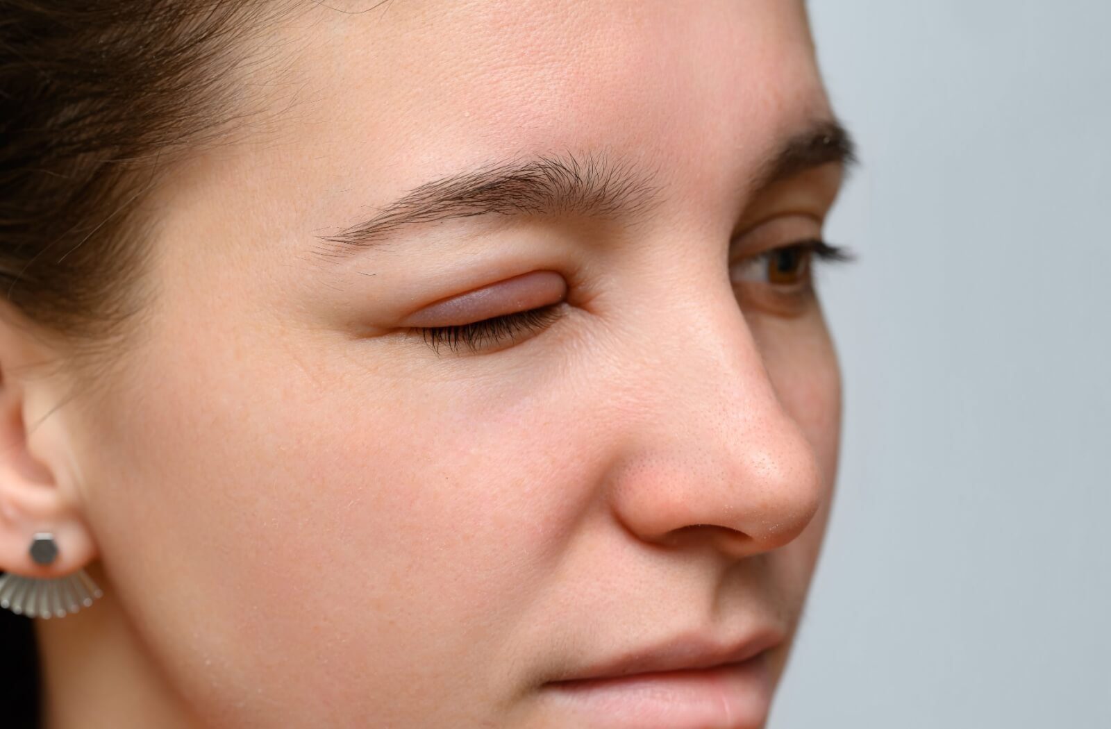A close-up of a woman's swollen right eye.