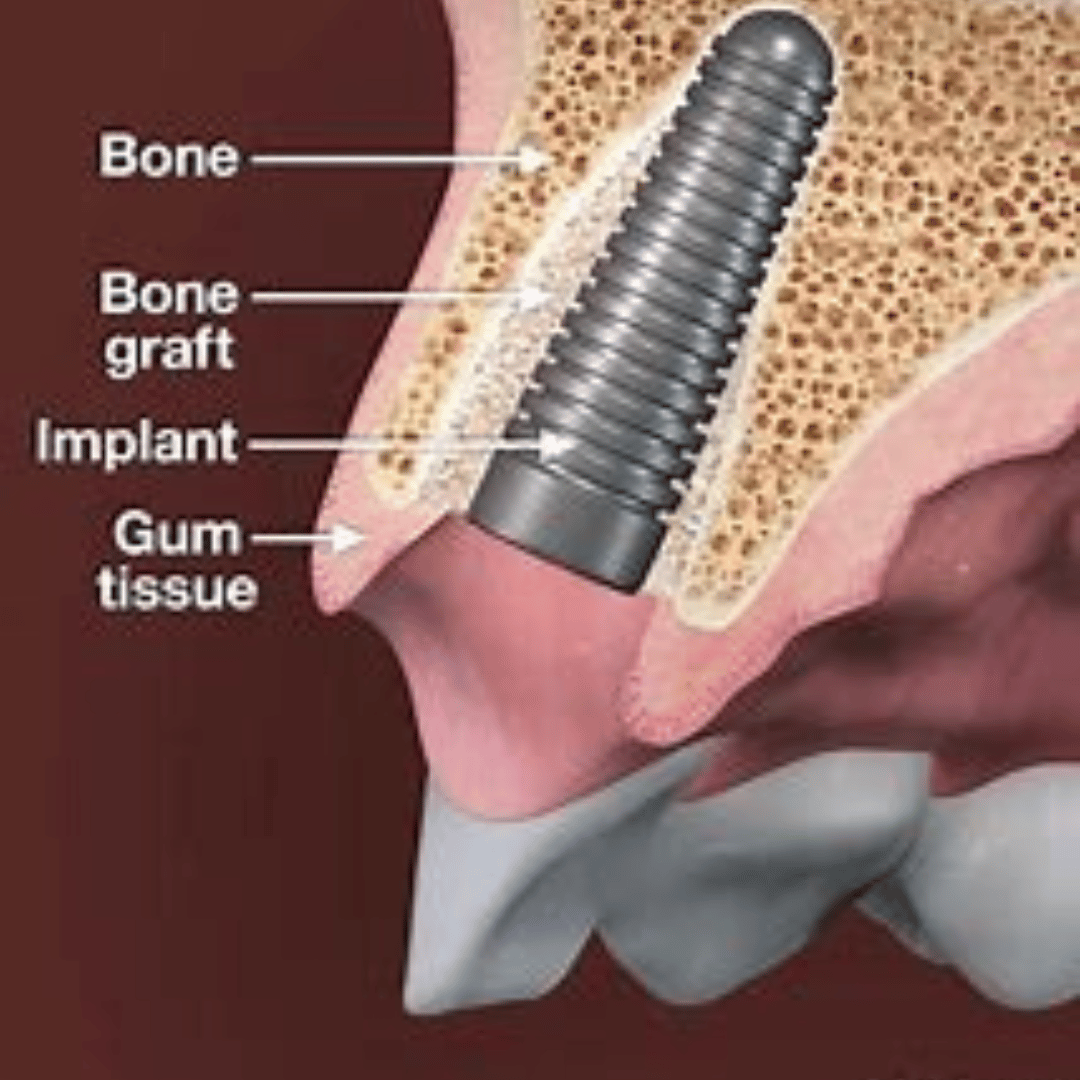 Bone Graft For Dental Implant