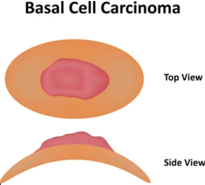 Basal Cell Carcinoma of Breast