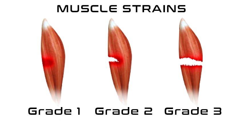 grades-of-muscle-strains