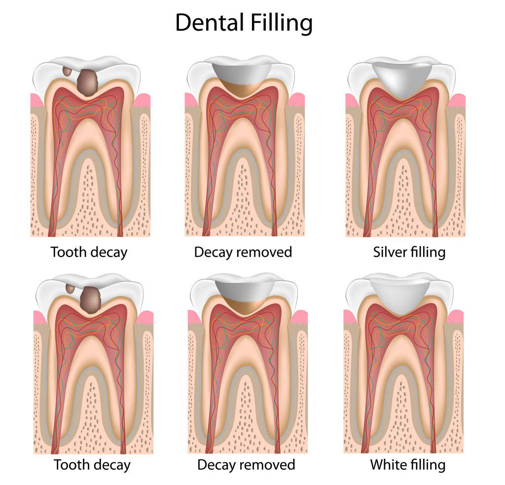 Dental Cavity Filling for Children  
