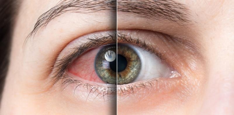 Dry Eye Syndrome at Robinson Optometrists, Opticians in Whitley Bay