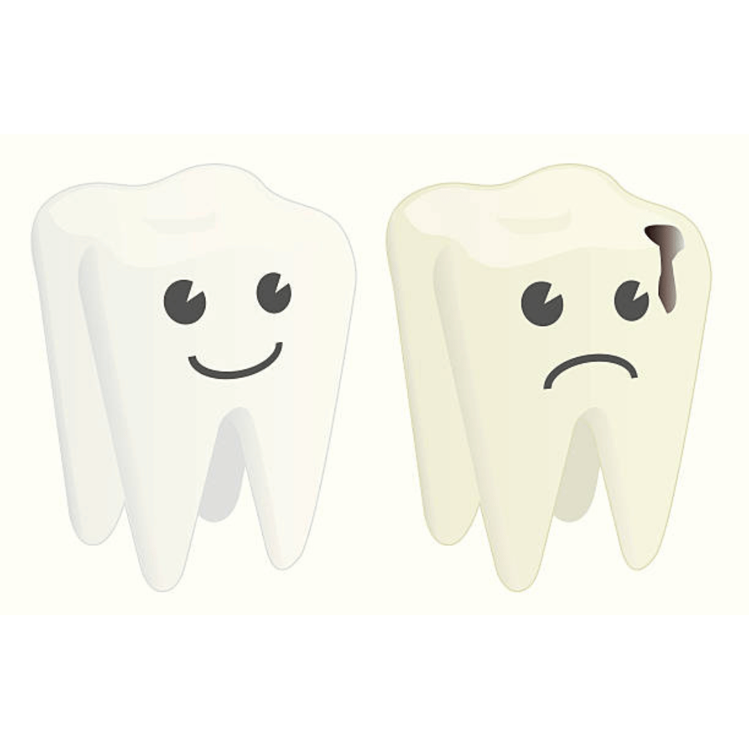 What to Do If Your Tooth Filling Fell Out?